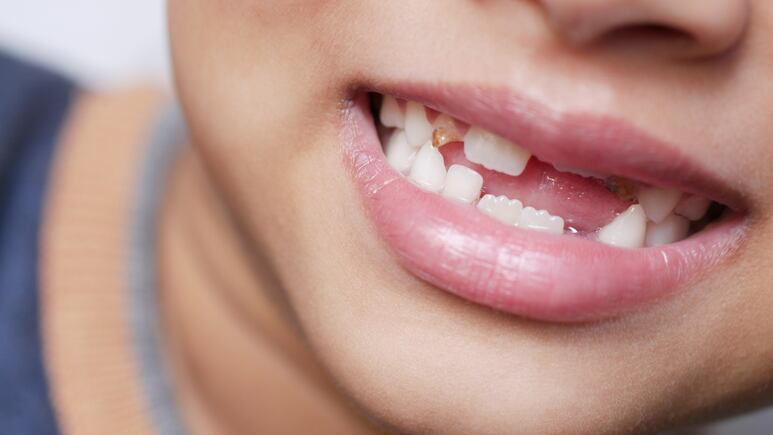 ¿Cuál es el significado de soñar que se te caen los dientes y cómo interpretarlo?