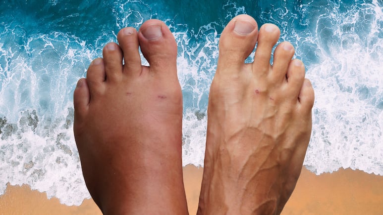 como-desinflamar-pies-hinchados-calor-vacaciones