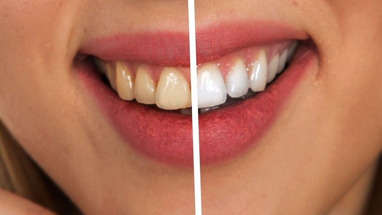 4 trucos fáciles para blanquear los dientes en 5 minutos sin dañar el esmalte