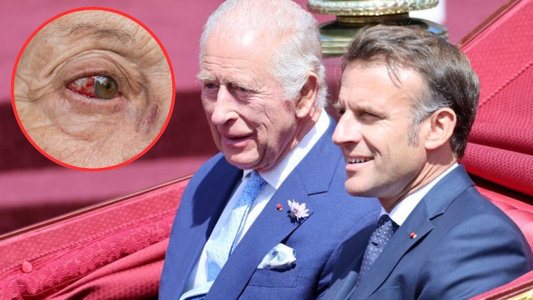 ¿Qué le ocurre al rey Carlos III Aparece con un ojo rojo y Buckingham aclara la situación