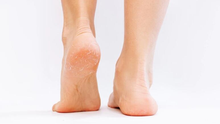 Spa en casa: 5 ingredientes de cocina para cuidar los pies secos y agrietados