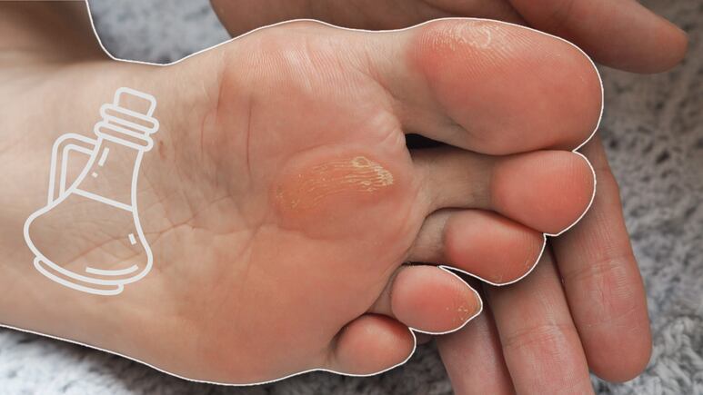 Truco con vinagre para eliminar la piel muerta de los pies con callosidades