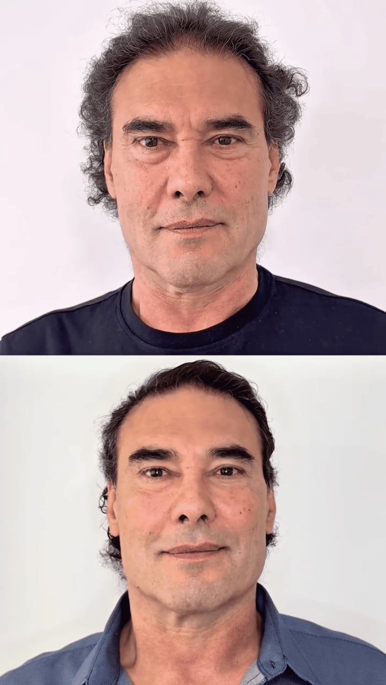 Antes y después del rejuvenecimiento facial de Eduardo Yáñez